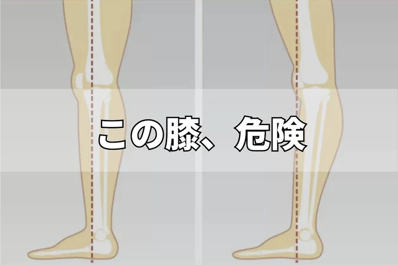堺筋本町の脚痩せ専門パーソナルジムが解説。脚痩せの天敵、反張膝。